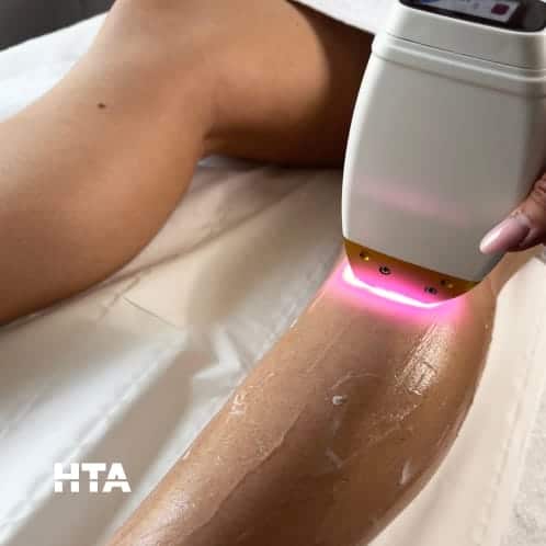 Séance d’épilation laser HTA 3Wave sur la jambe